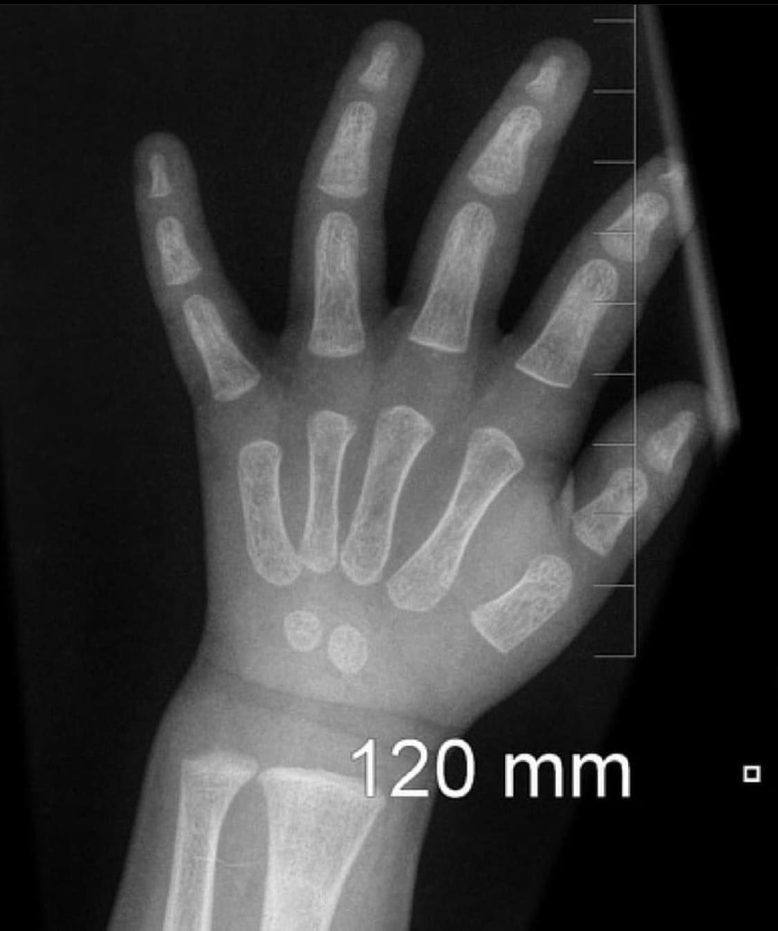 صورة (2) ليد طفل يبلغ تقريبًا عامين بالأشعة السينية (X-ray).
